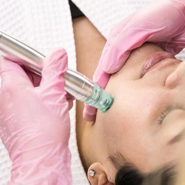 Microdermabrasion