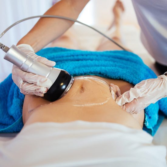Using ultrasonic cavitation to reduce cellulite and tighten skin on the stomach.